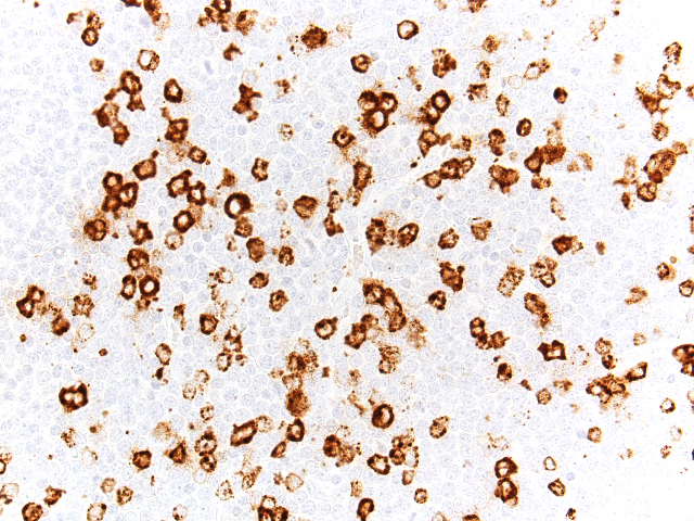Lymph node biopsy, lymphoid-predominant area, MPO